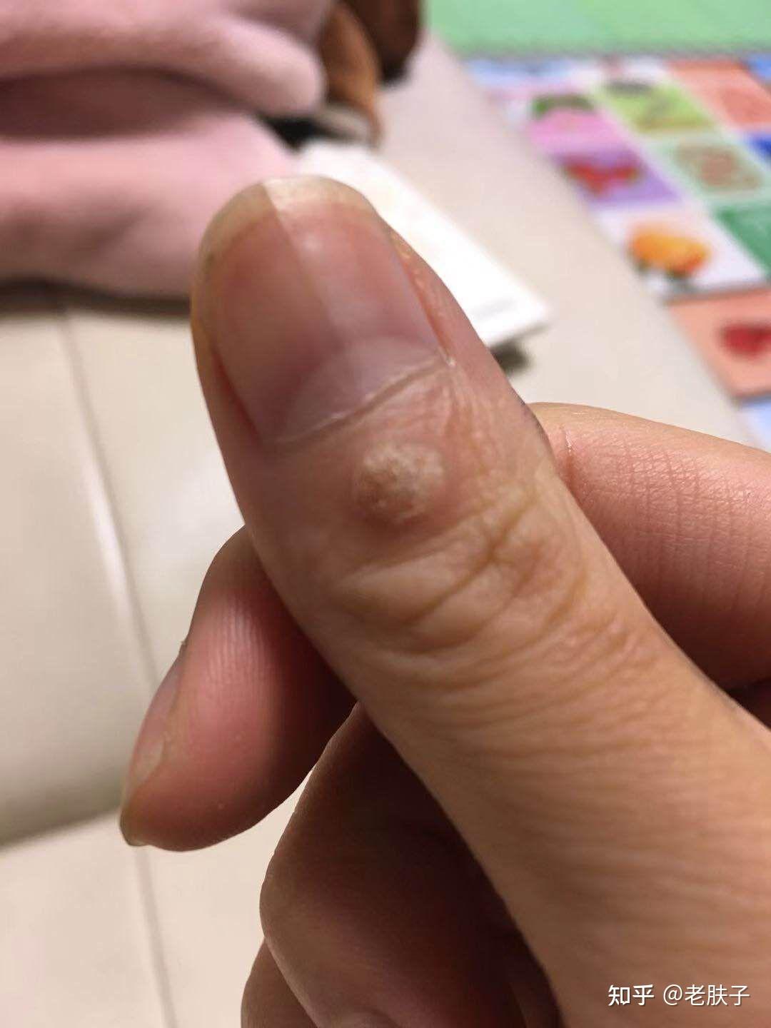 我手指头上长得是什么东西大神给看看呗