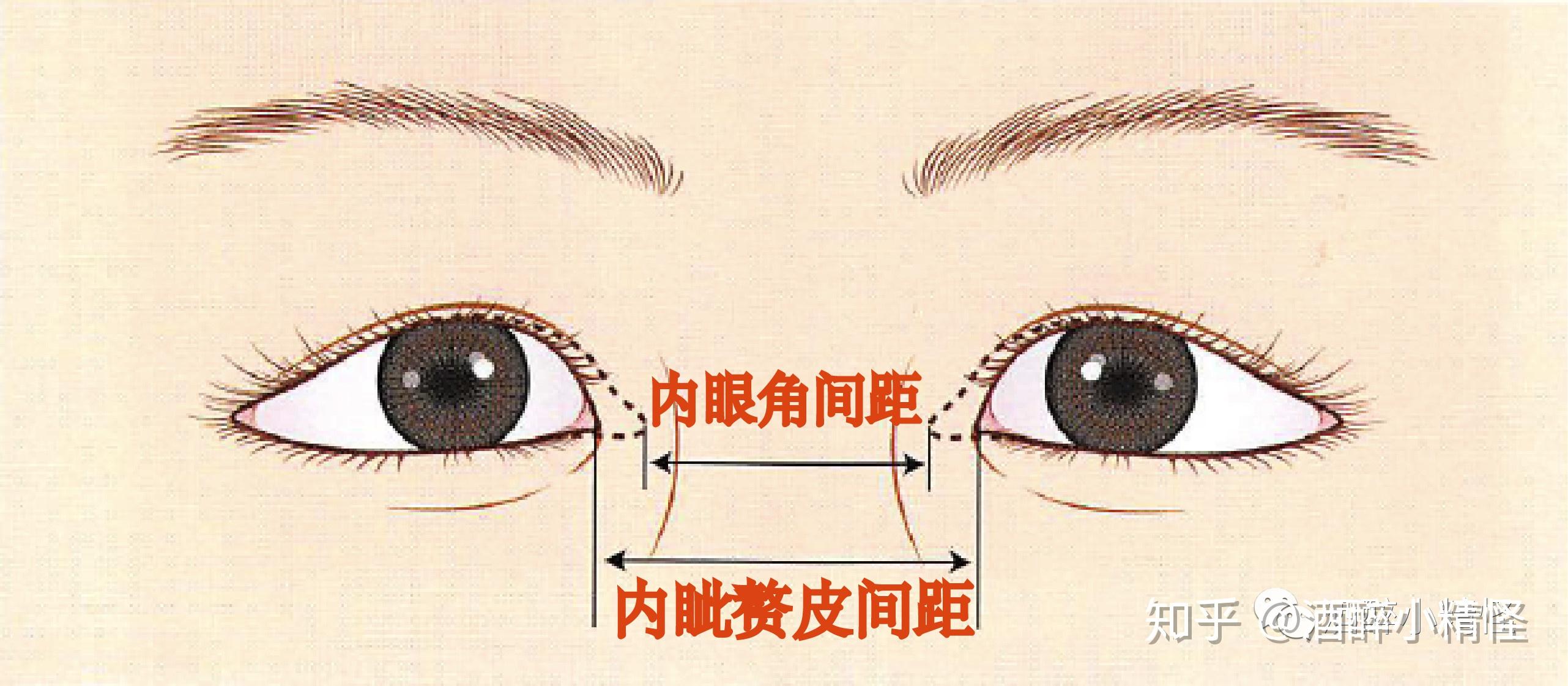 记录下开眼角双眼皮恢复过程 - 知乎