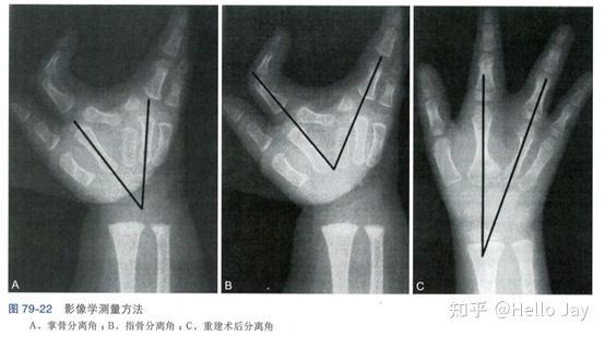 先天性手部畸形-形成障碍(发育停止) - 知乎