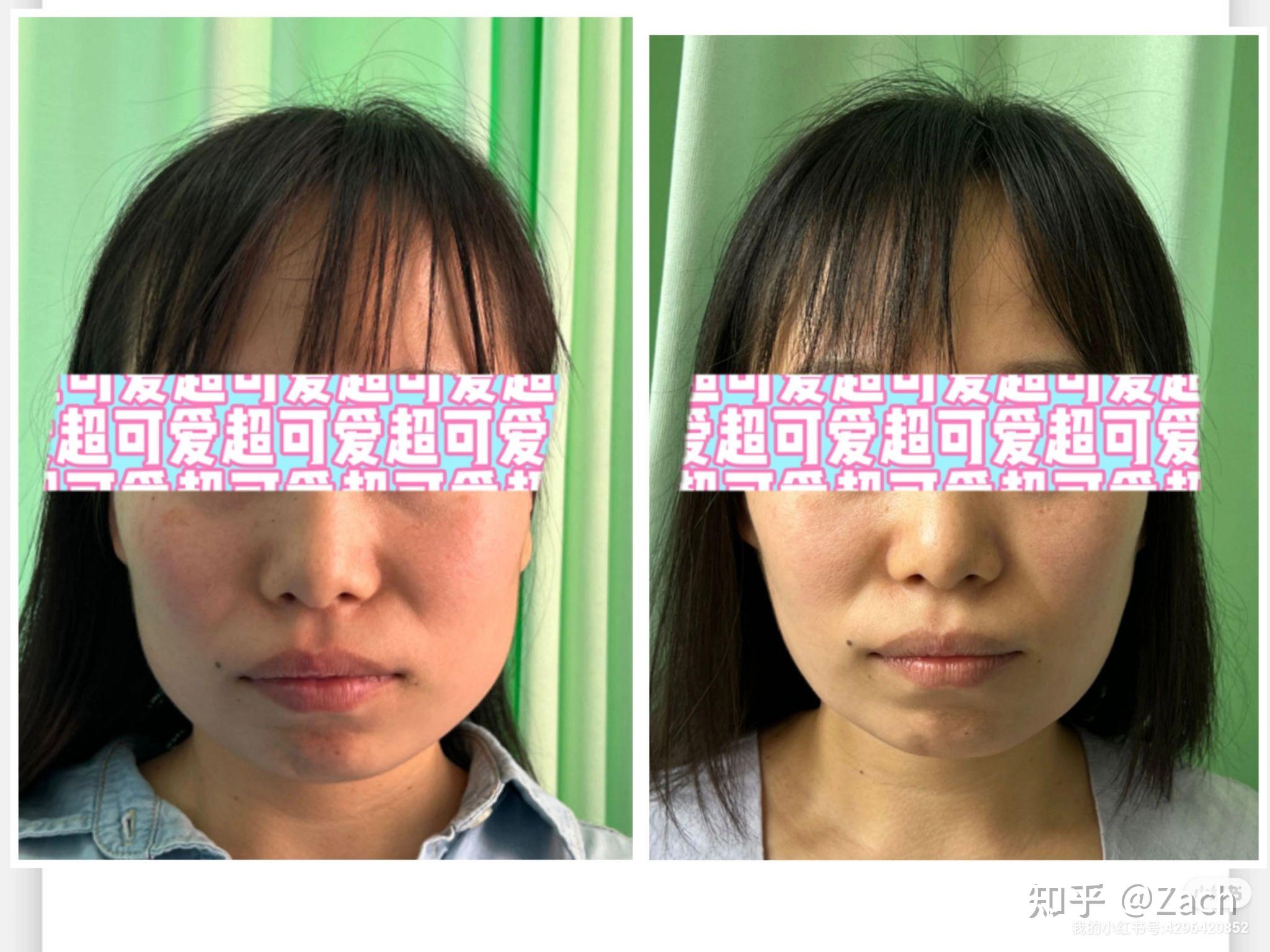医疗美容瘦脸针海报_Felix羊丰-站酷ZCOOL