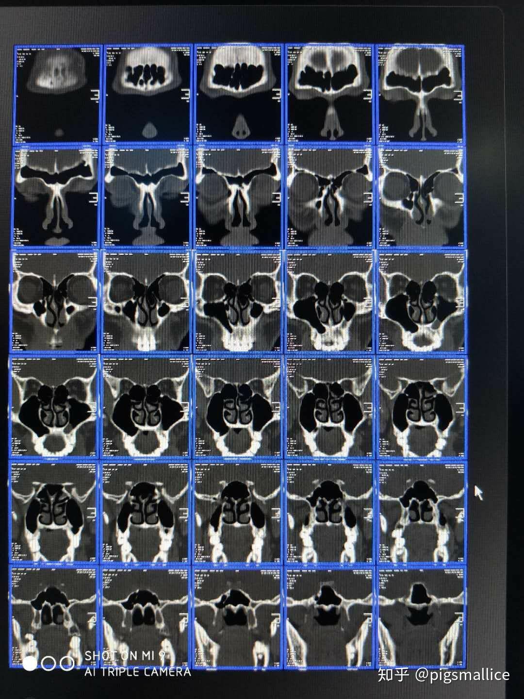 副鼻窦ct检查发现上颌窦有两个囊肿怎么办求助