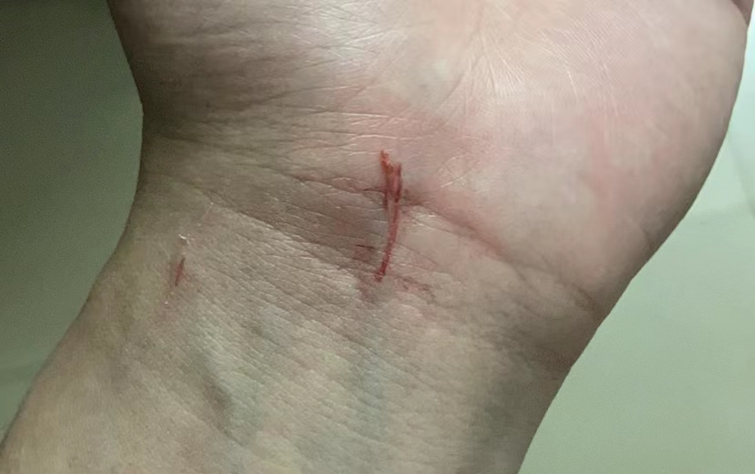 不小心被猫咪抓伤咬伤了怎么办?铲屎官须知 - 知乎