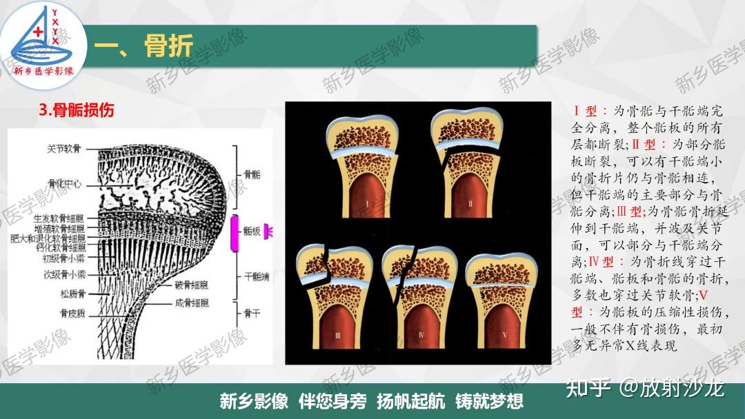 骨骺损伤及常见各类骨折的分型及诊断 - 知乎