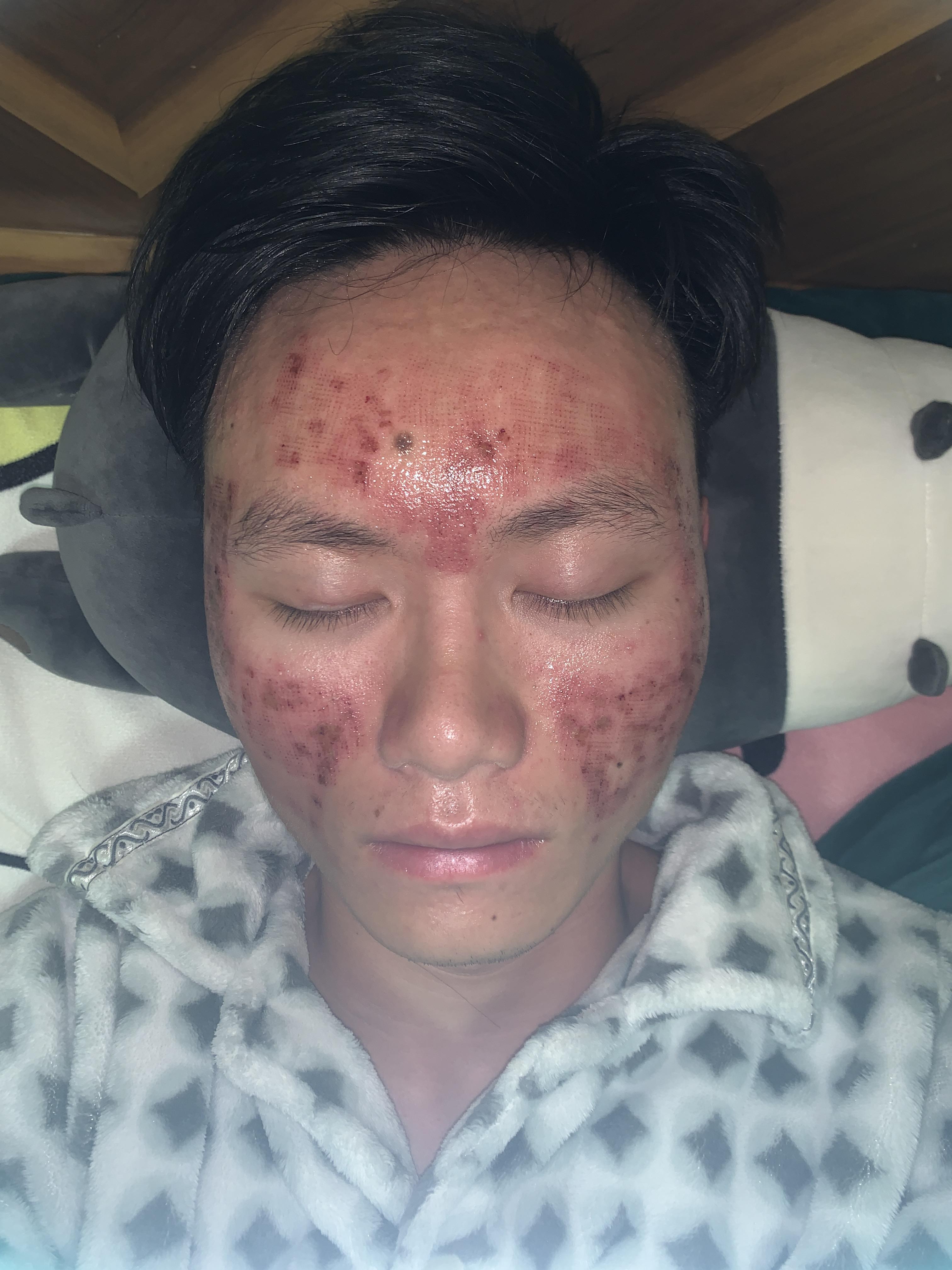 点阵激光祛痘坑是什么样的体验