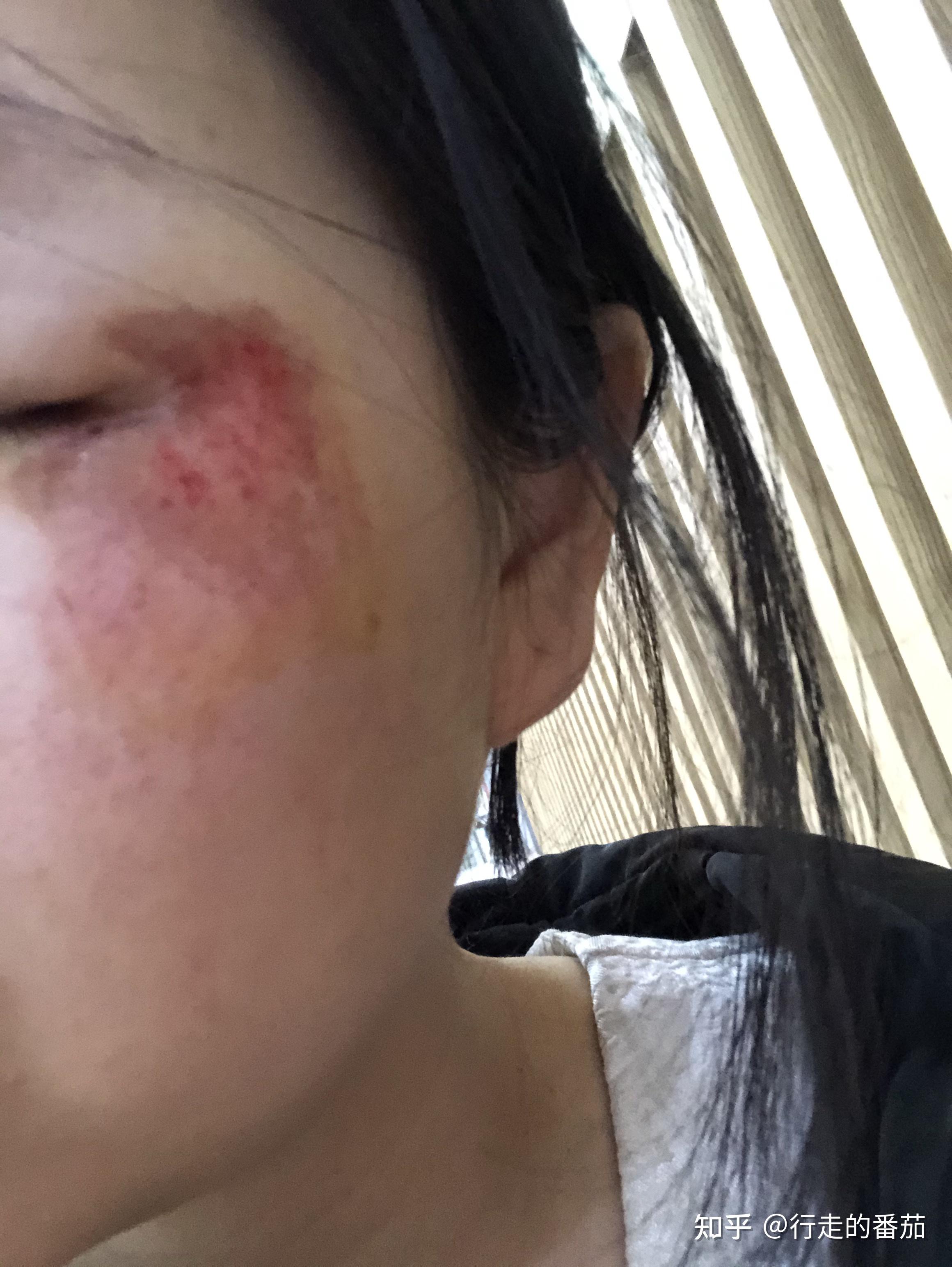 脸摔破了怎么才能不留疤