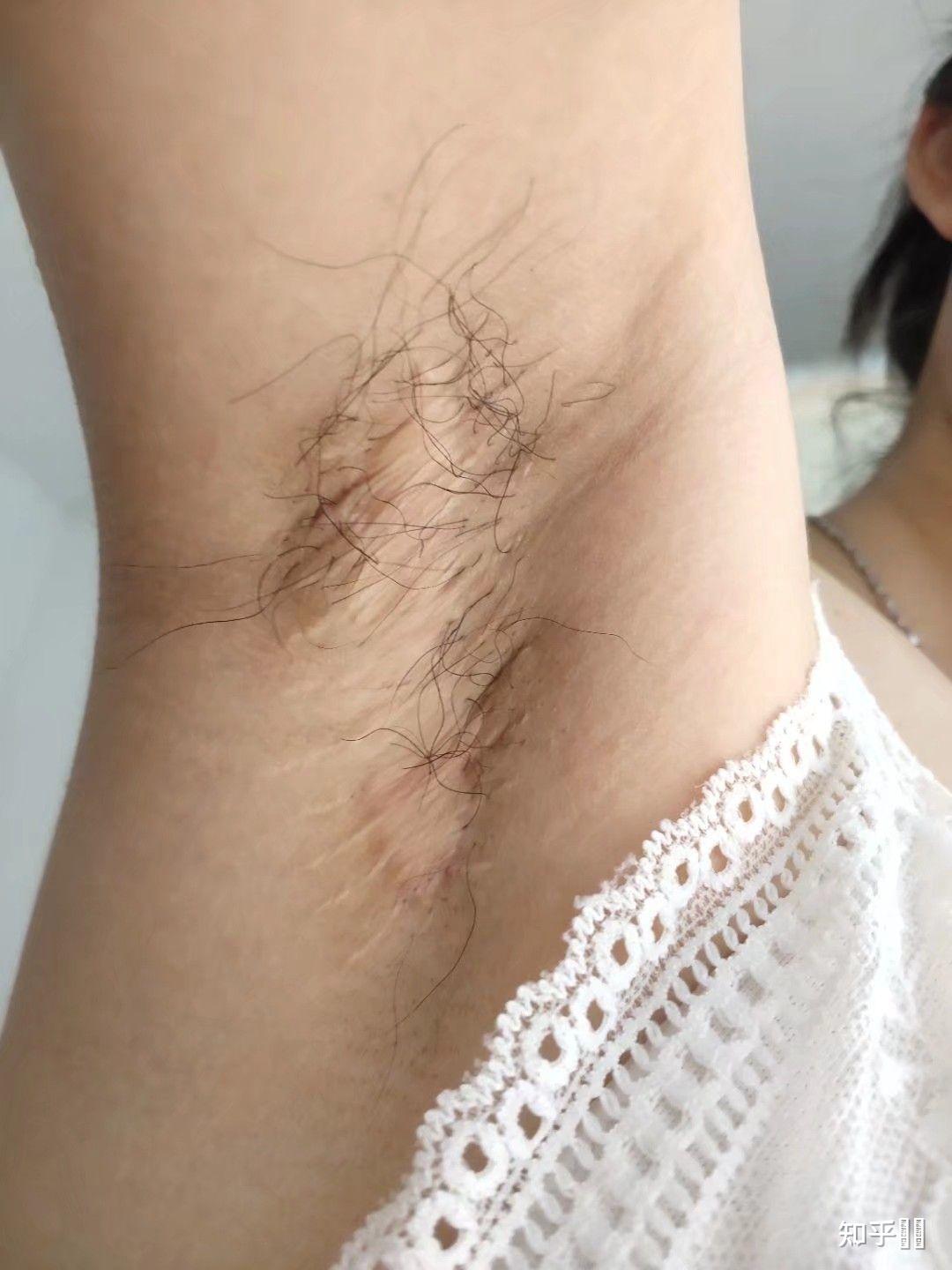 做腋下大汗腺切除手术是什么体验