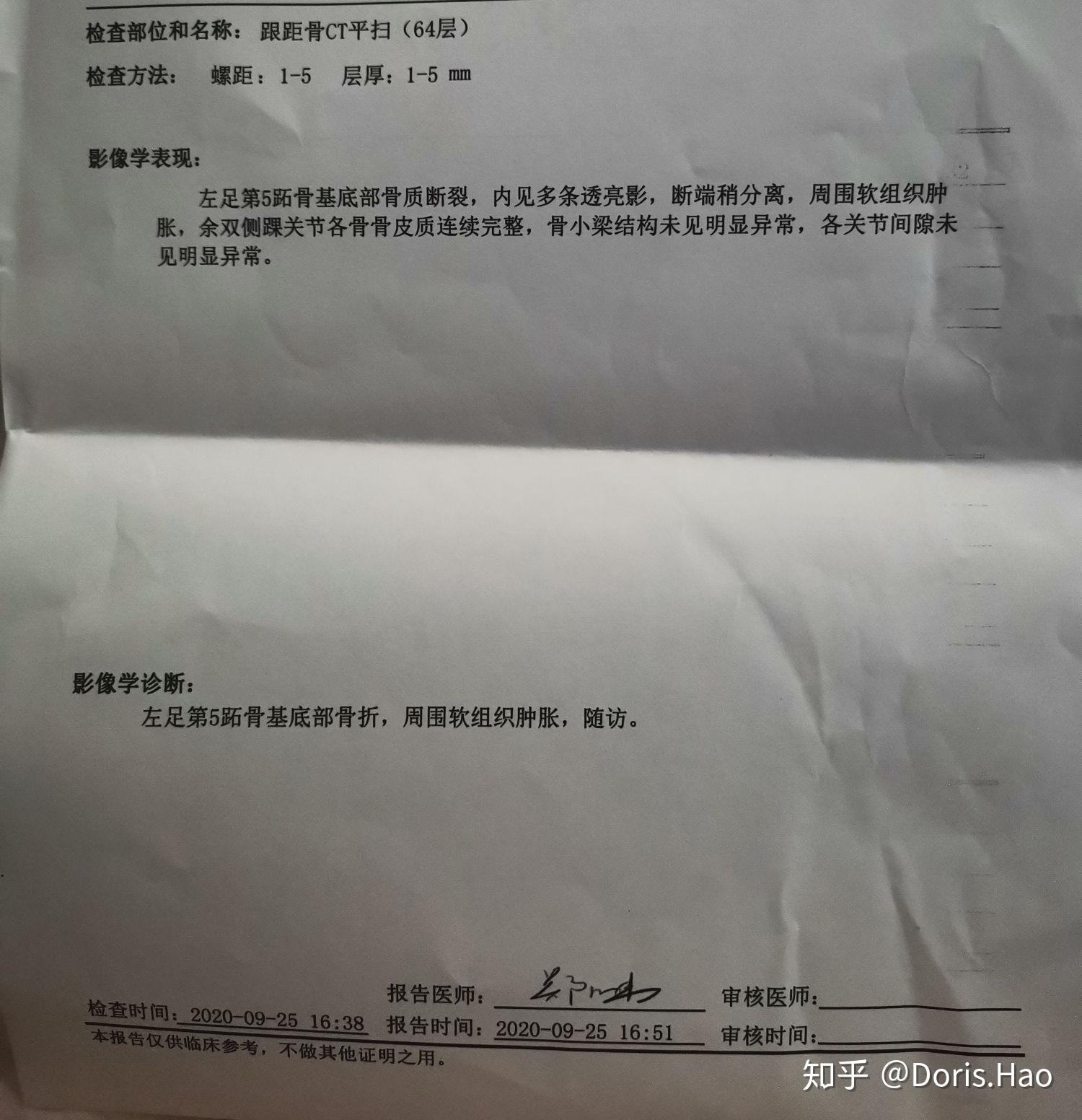 第五跖骨基底部骨折恢复过程