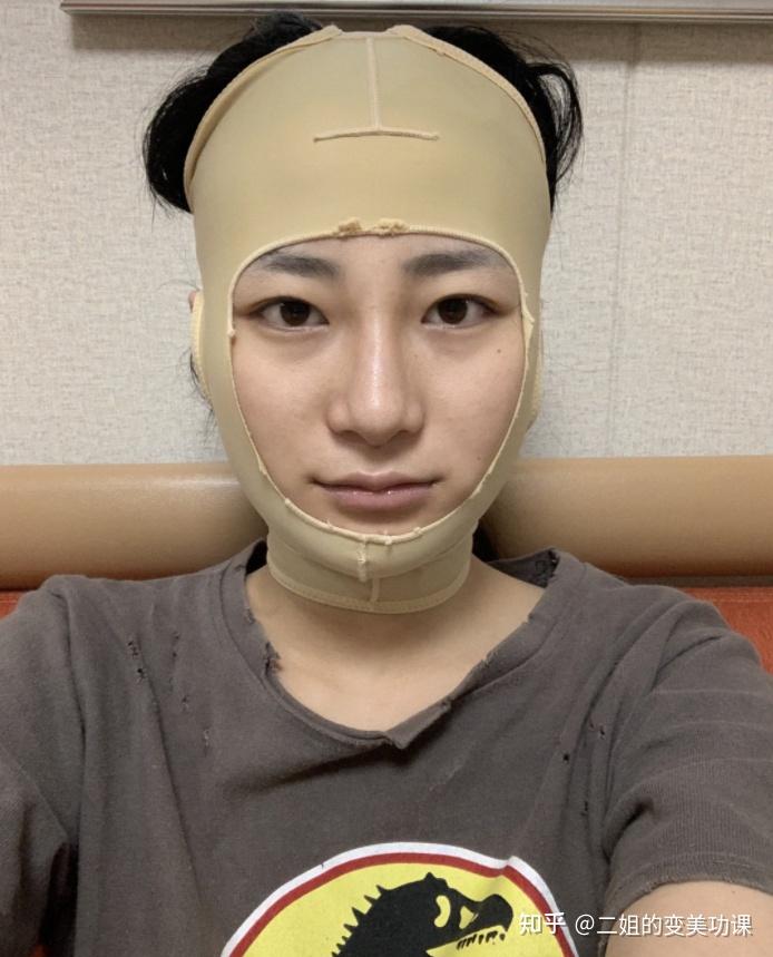 成都磨骨日记分享,下颌角太宽了,颧骨太高,直接削了!