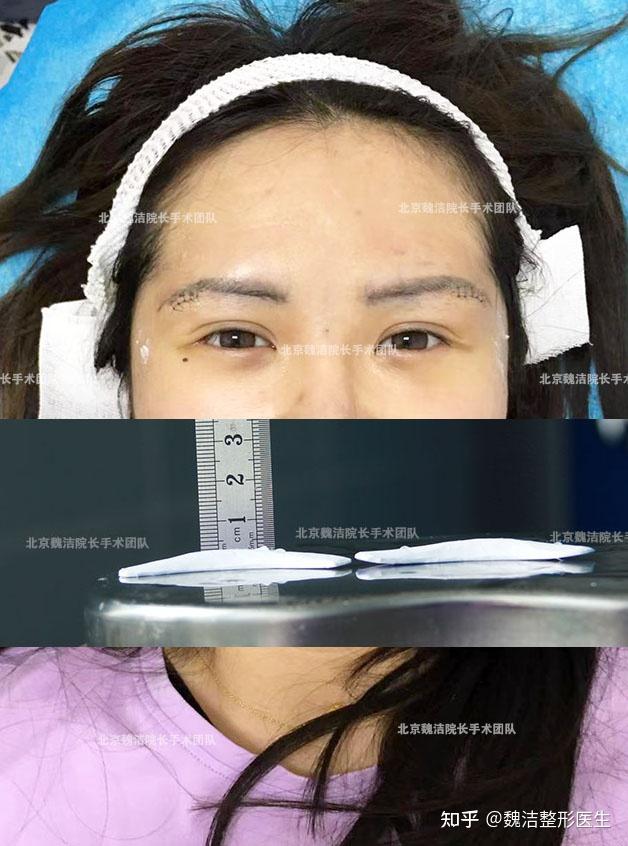 垫眉弓手术不是独立的 务必兼顾眉心及额颞部的衔接过渡 方可获得自然柔和的眉骨形态 - 知乎