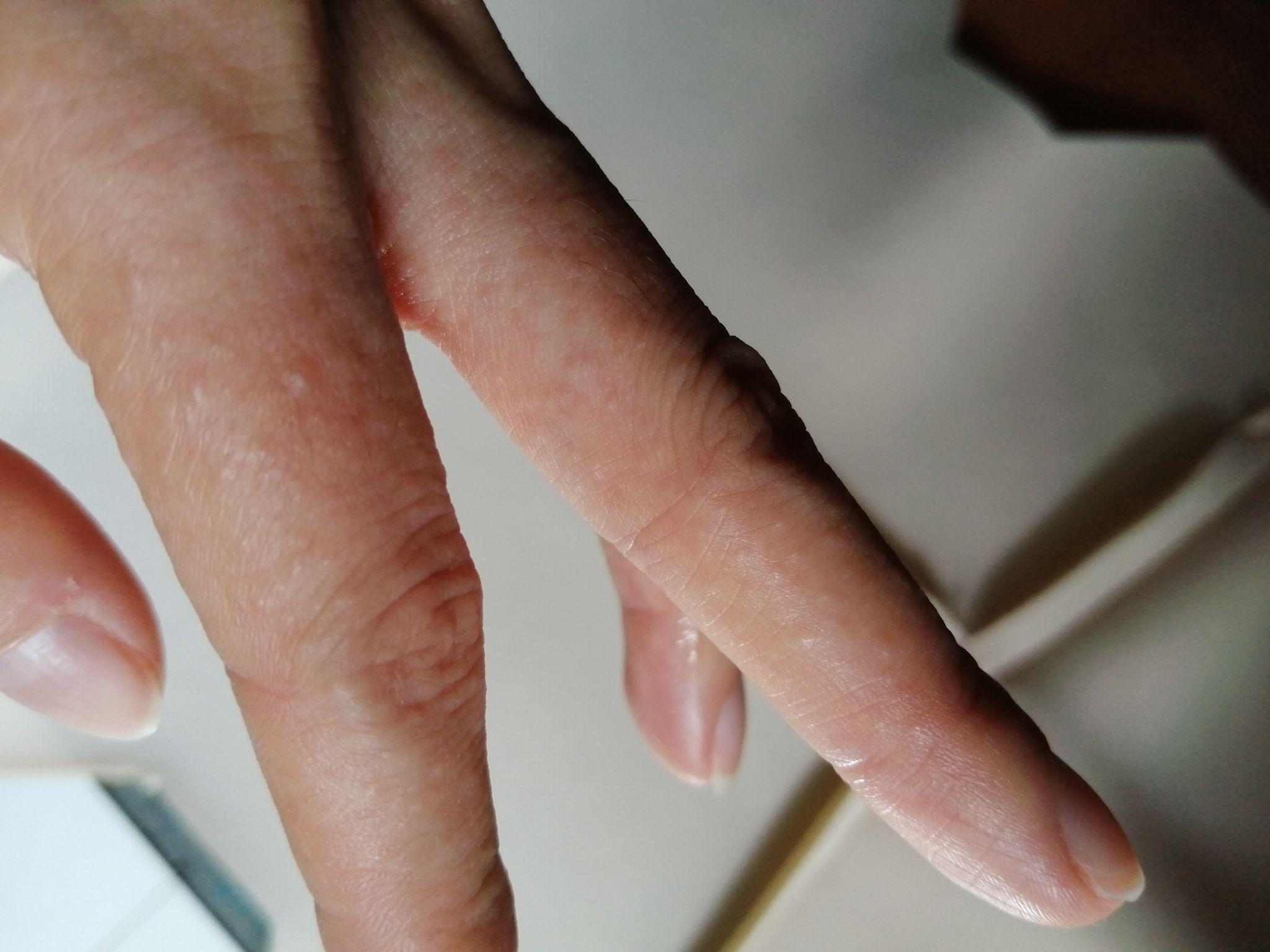 手背上长了一片小疙瘩,密密麻麻的,鼓起来的,刚洗完澡就有点痒,是湿疹