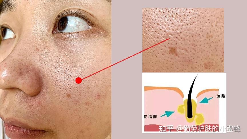 【毛孔粗大必看】把握住28天肌肤更新周期,简单又高效的保姆级教程分享,从毛孔大得能插秧到紧致毛孔,3步让你美美拥有细腻肌肤~ - 知乎