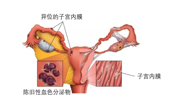 卵巢的子宮內膜異位症就屬於複雜的卵巢囊腫的一種,它是指子宮內膜