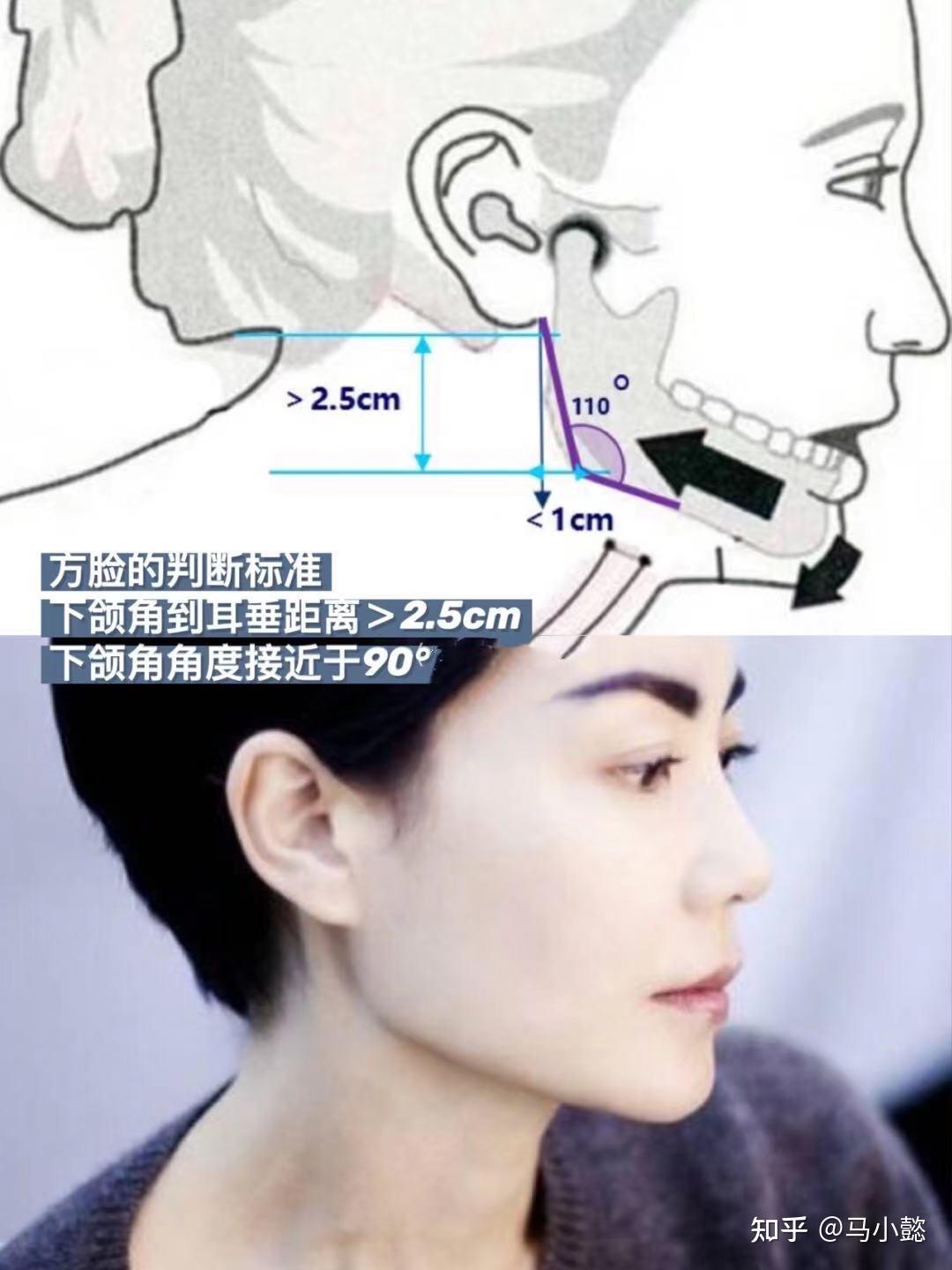 隆鼻审美|微驼峰鼻最全功课+全国擅长驼峰鼻的隆鼻医生盘点！（附案例） - 知乎