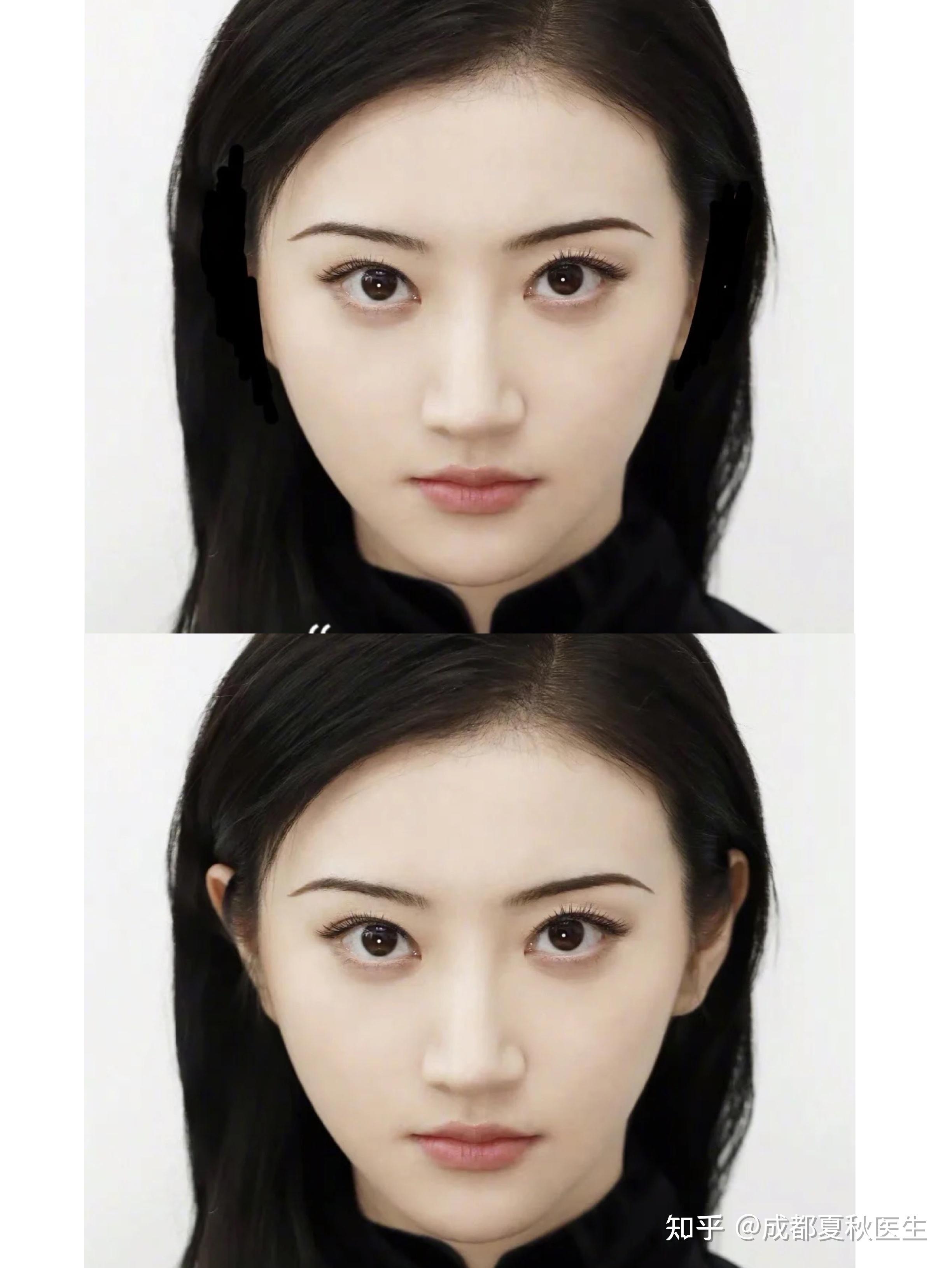 外轮廓固定之耳基底提升 - 知乎