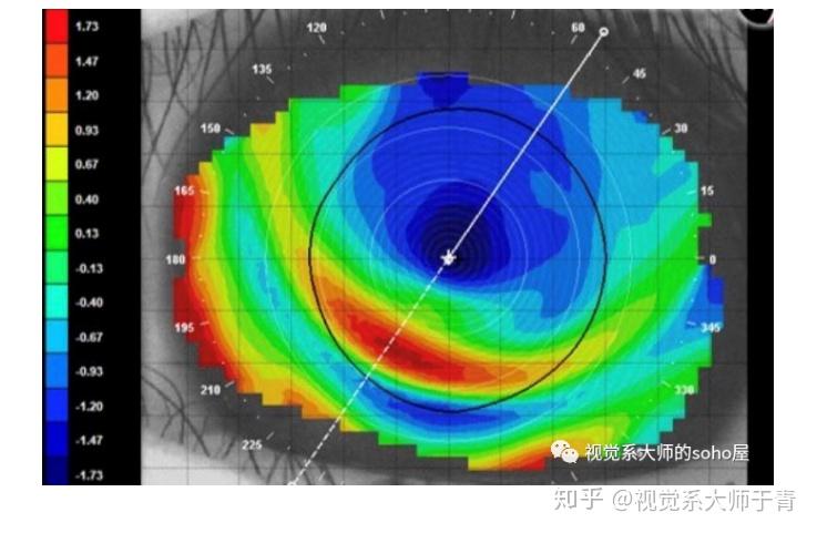 左图丨ok镜荧光染色                     右图丨塑形后角膜地形图