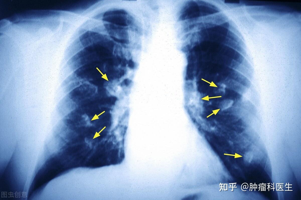 年年体检正常，为何还会查出肺癌晚期？医生：只因你没做好这事-搜狐大视野-搜狐新闻