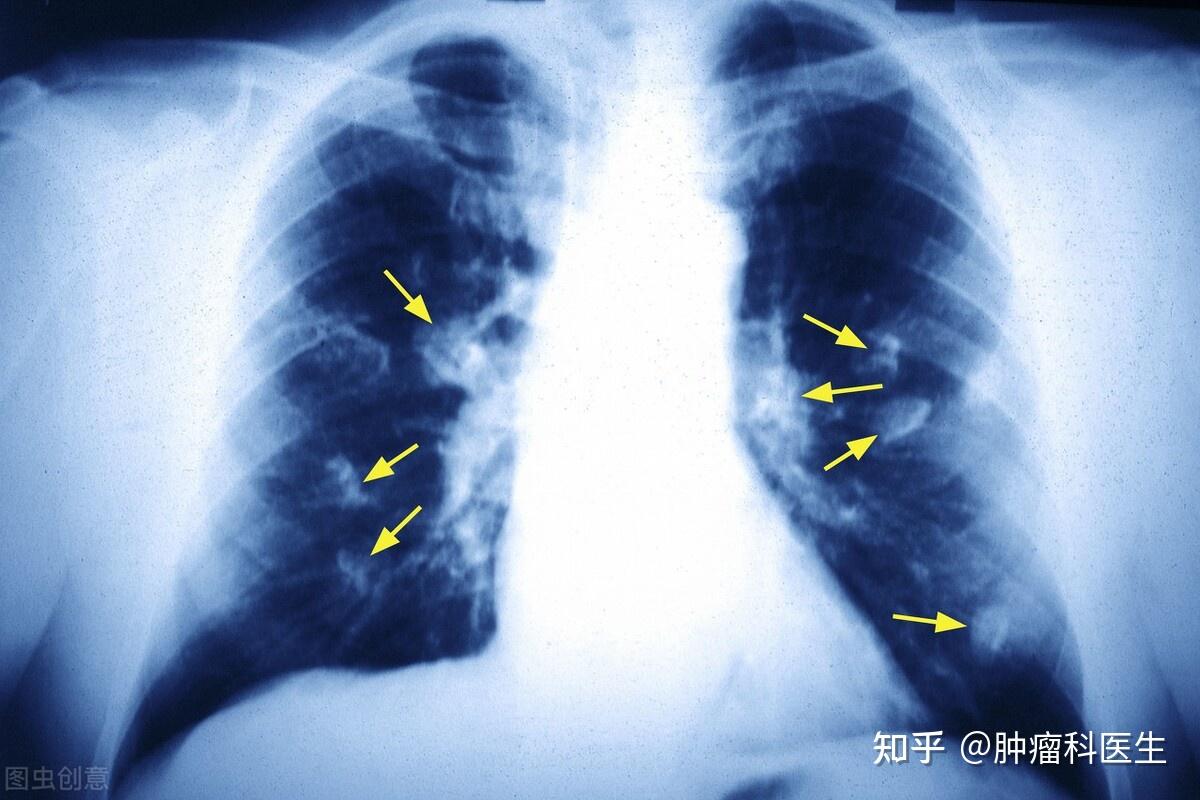 晚期肺癌能活多久？我已经陪爸爸抗癌6年了 - 知乎