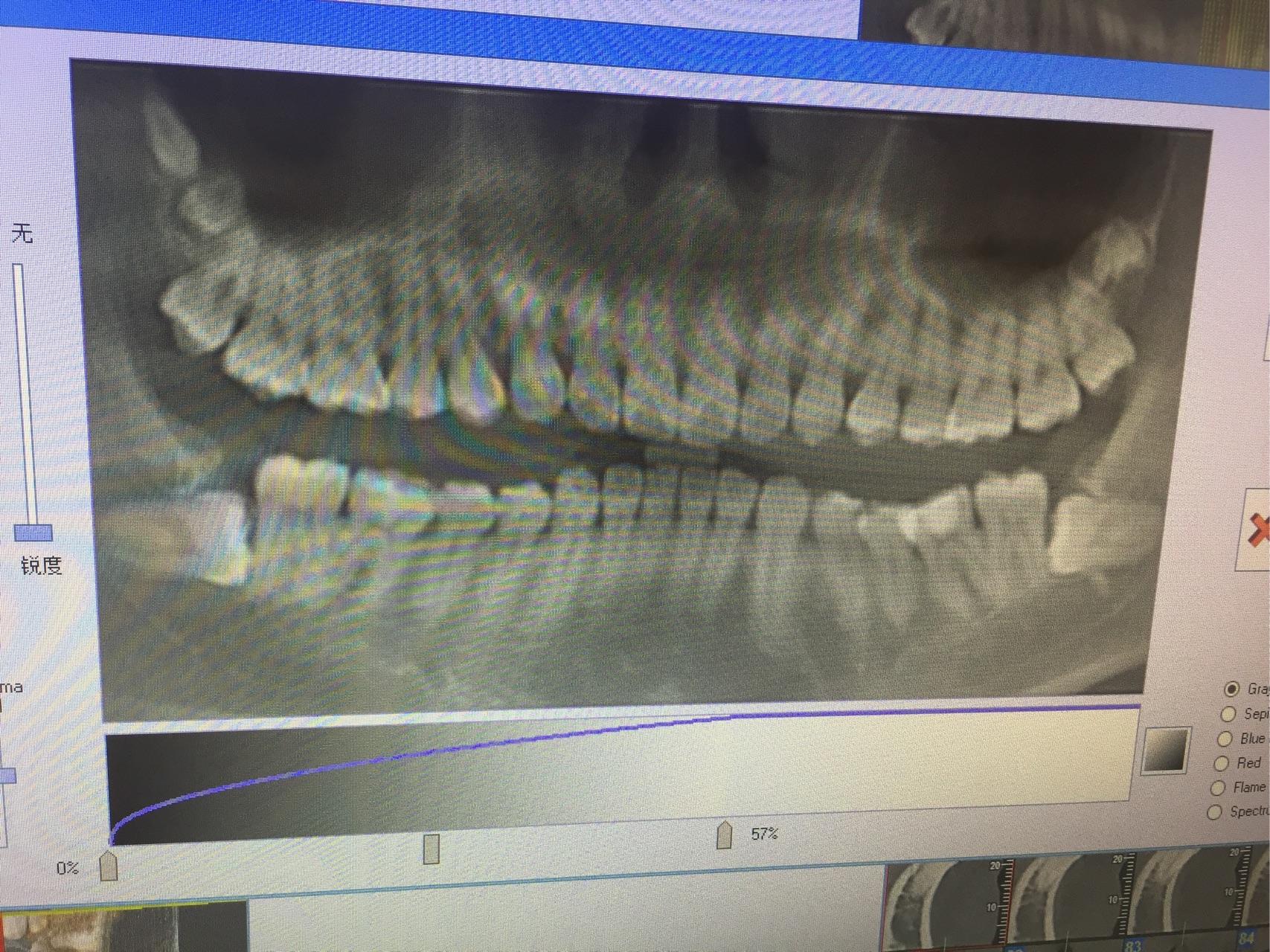 请问这两颗水平阻生齿拔掉有难度么