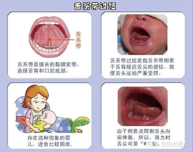 新生儿舌头连着筋的图图片