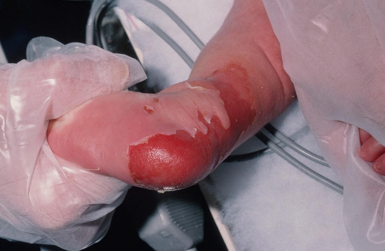 关于最近在网上看到的保鲜膜男孩很惨,大疱性表皮松解症,据说没有能