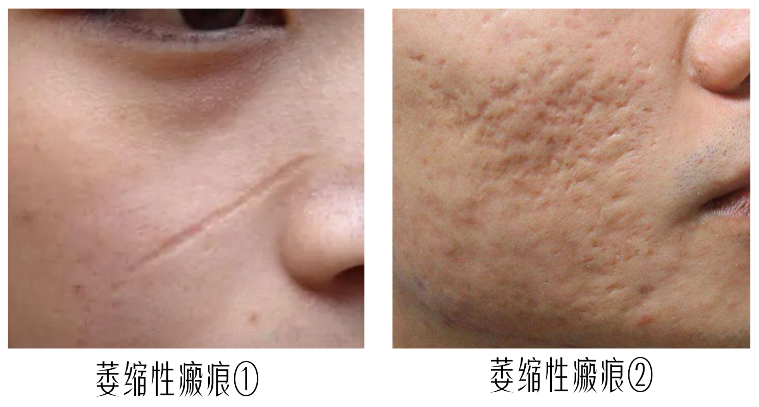 【协和硕士出品】医美科普,怎么祛疤痕最有用? 全网最干/祛疤指南