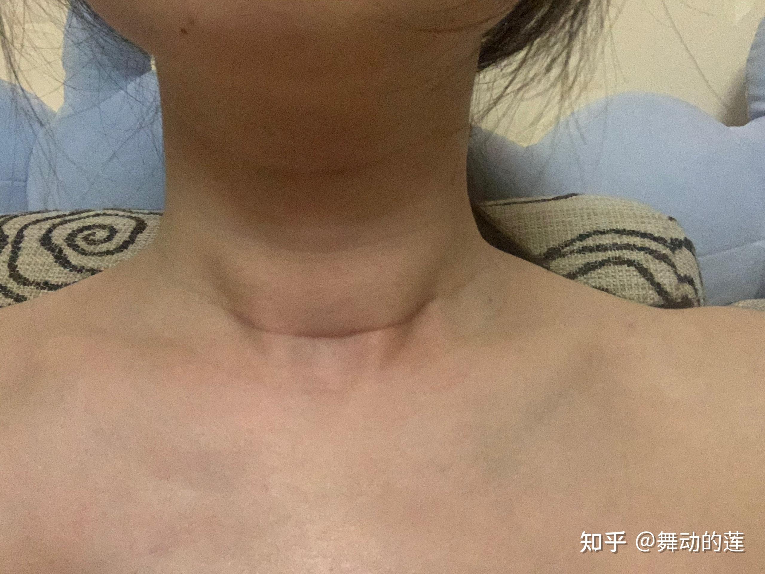 甲狀腺乳頭狀癌濾泡亞型術後恢復過程