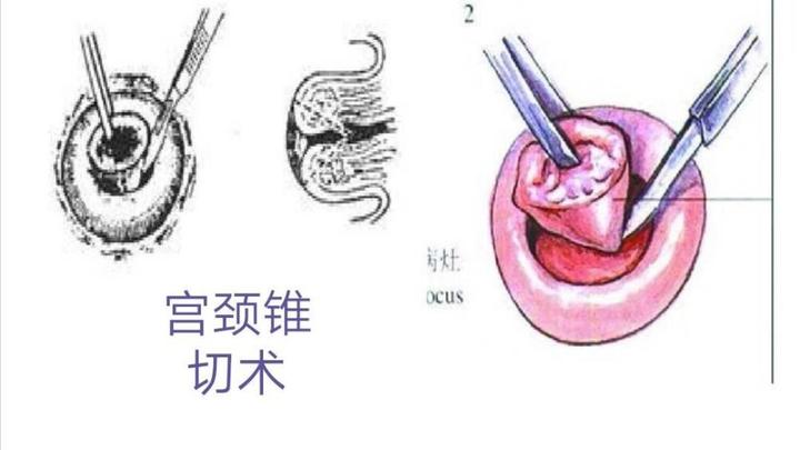 宫颈病变