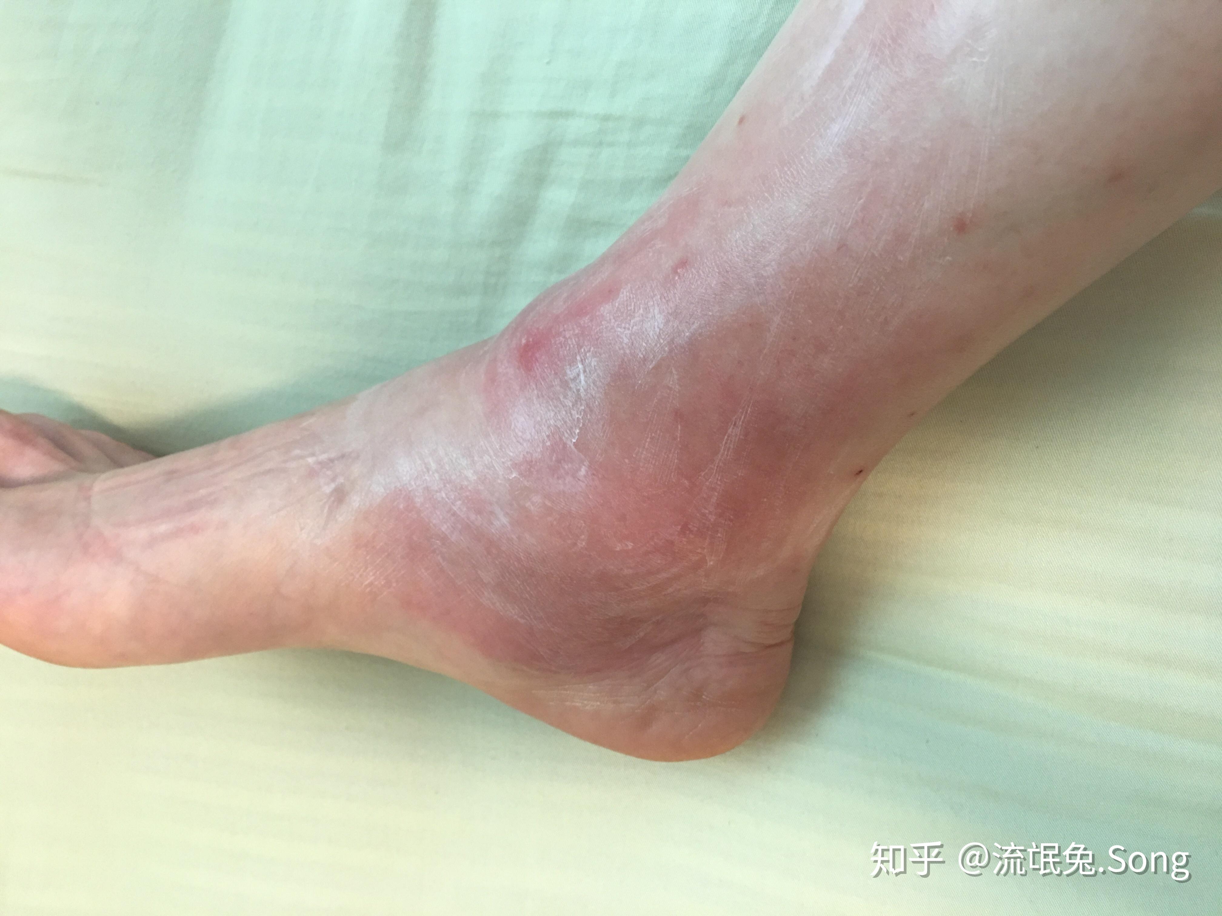 被蚂蚁咬怎么处理