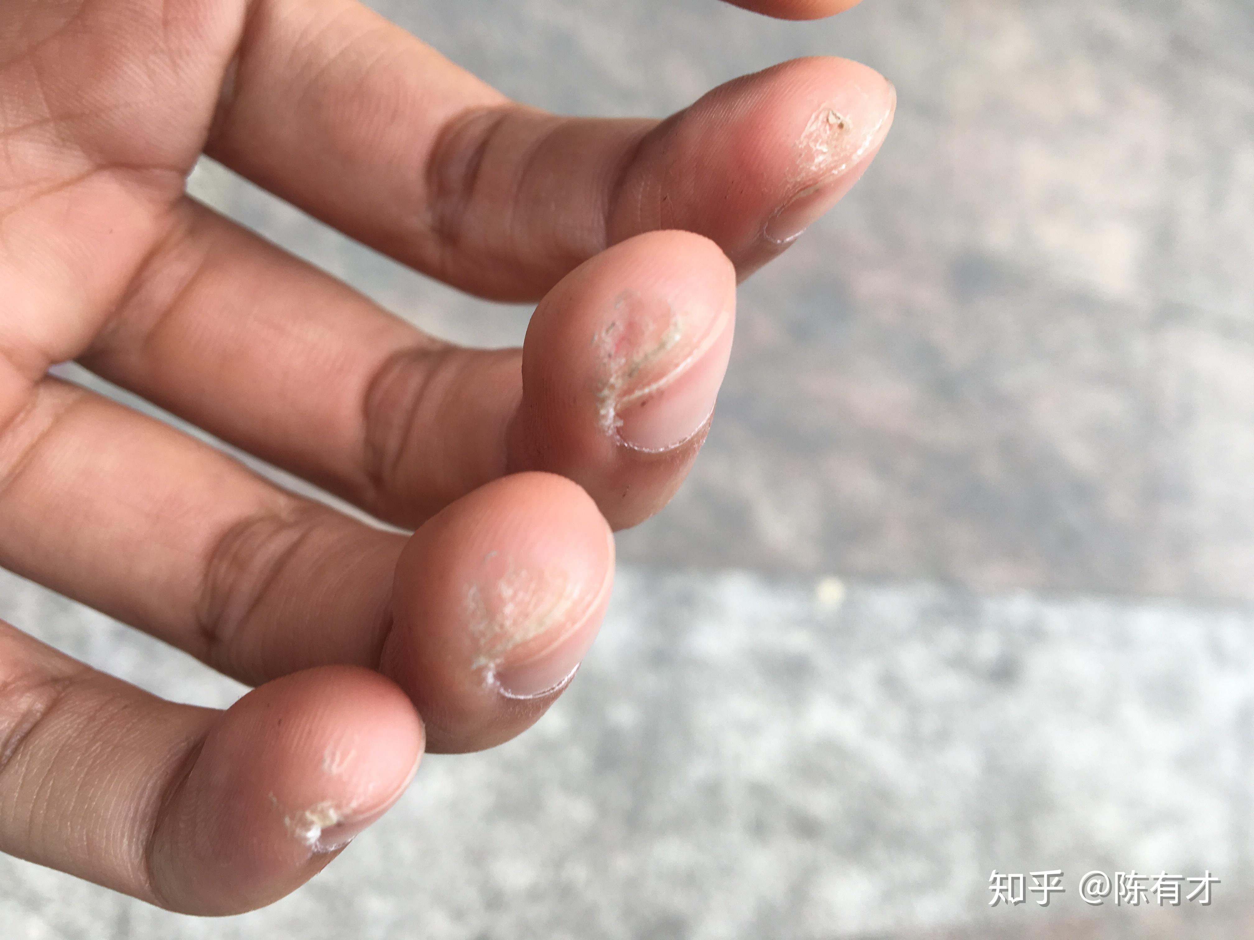 玩吉他的朋友可以拍一张左手手指上的茧吗? - 知乎