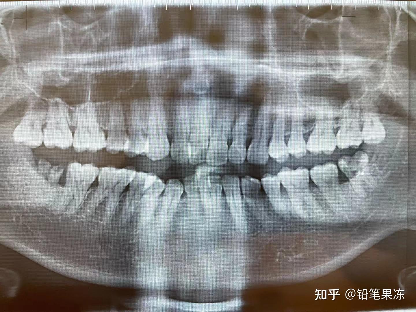 案例：正畸牵引水平阻生智齿代替缺失磨牙 - 哔哩哔哩
