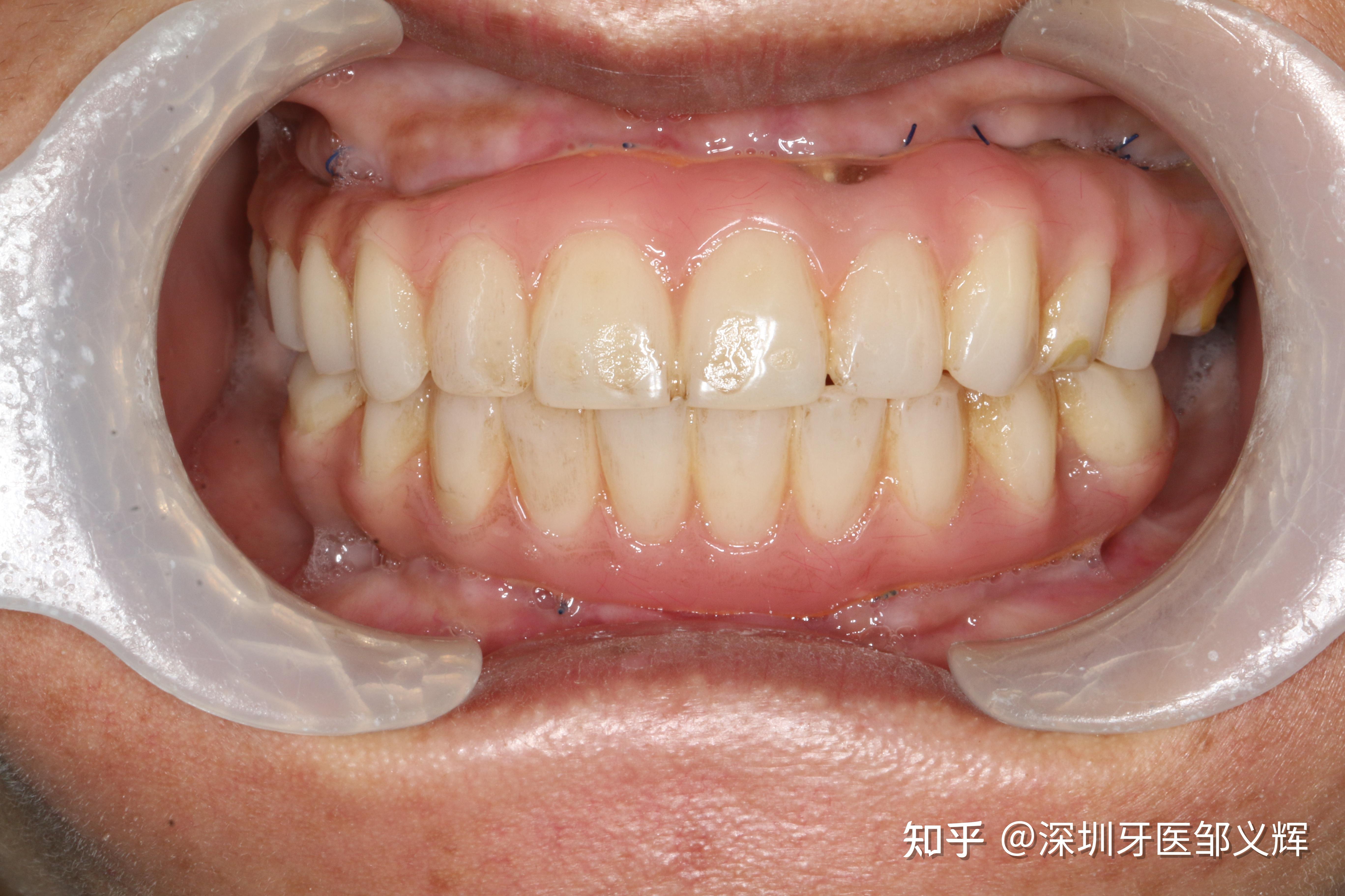 无牙颌修复一例