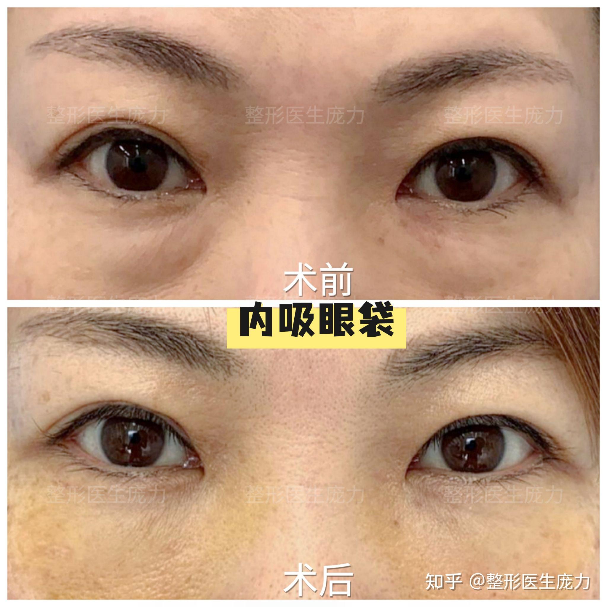 内吸眼袋合集