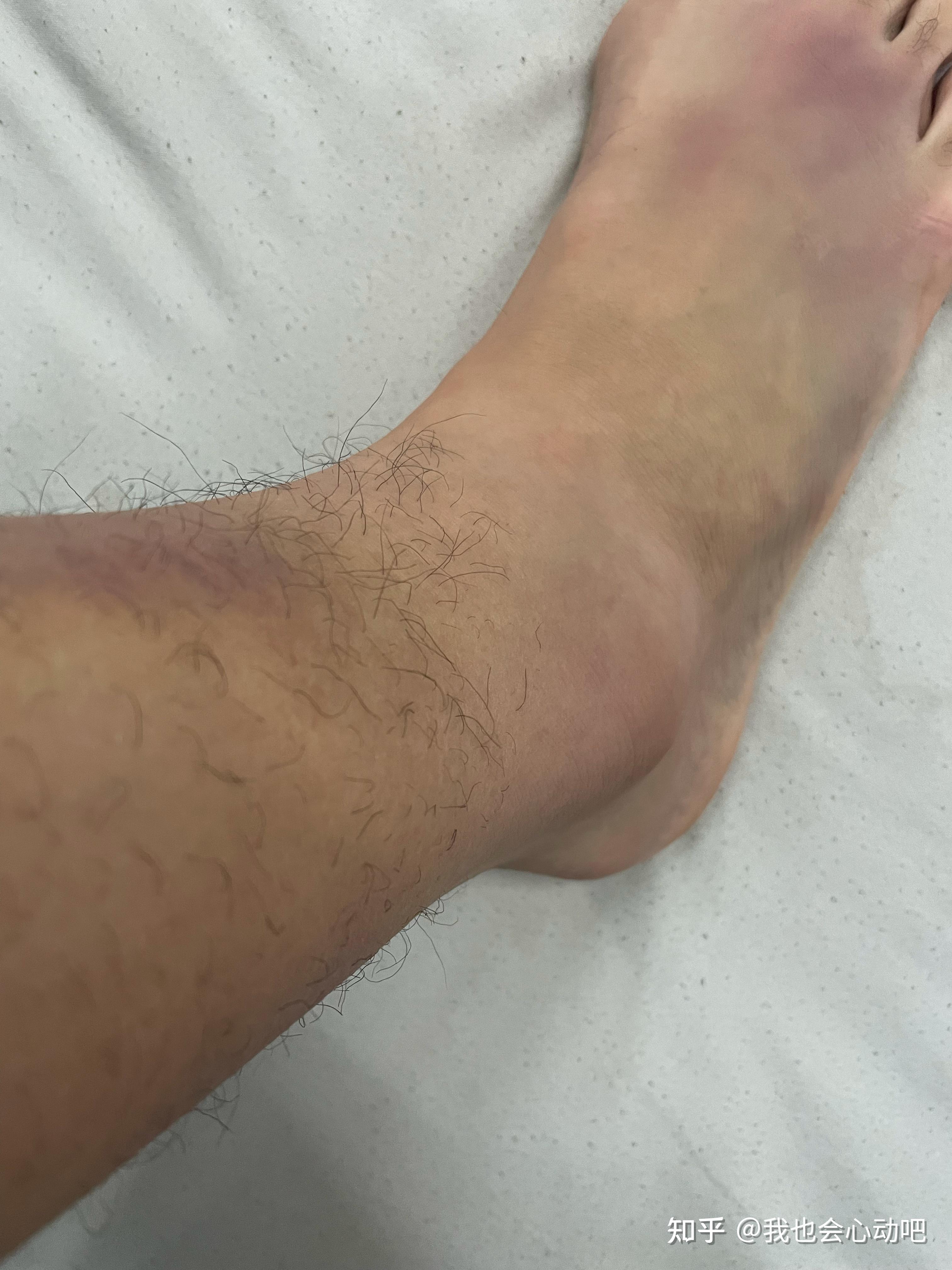 脚崴了肿了如果不及时处理会怎样? - 知乎