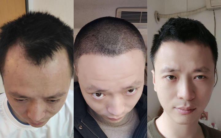 植发前后的照片 - 知乎