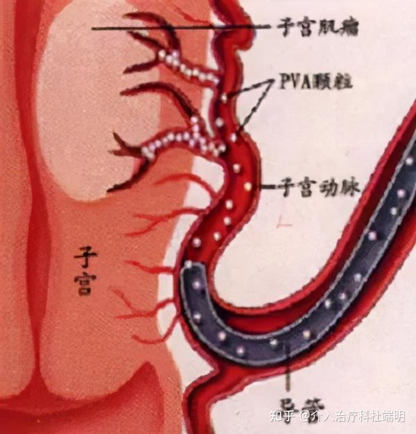 子宫平滑肌瘤手绘图图片