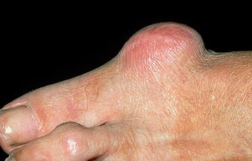 拇囊炎该如何治疗才有效