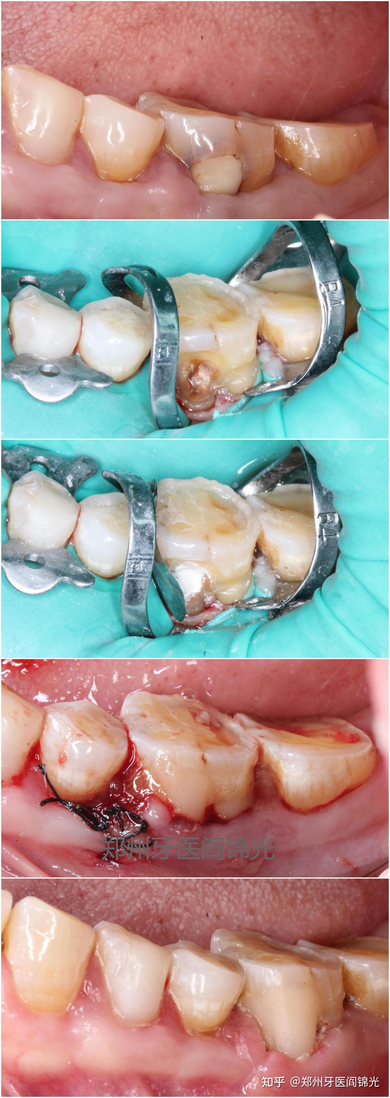 牙周膜龈手术+植骨（PAOO）记录 - 知乎