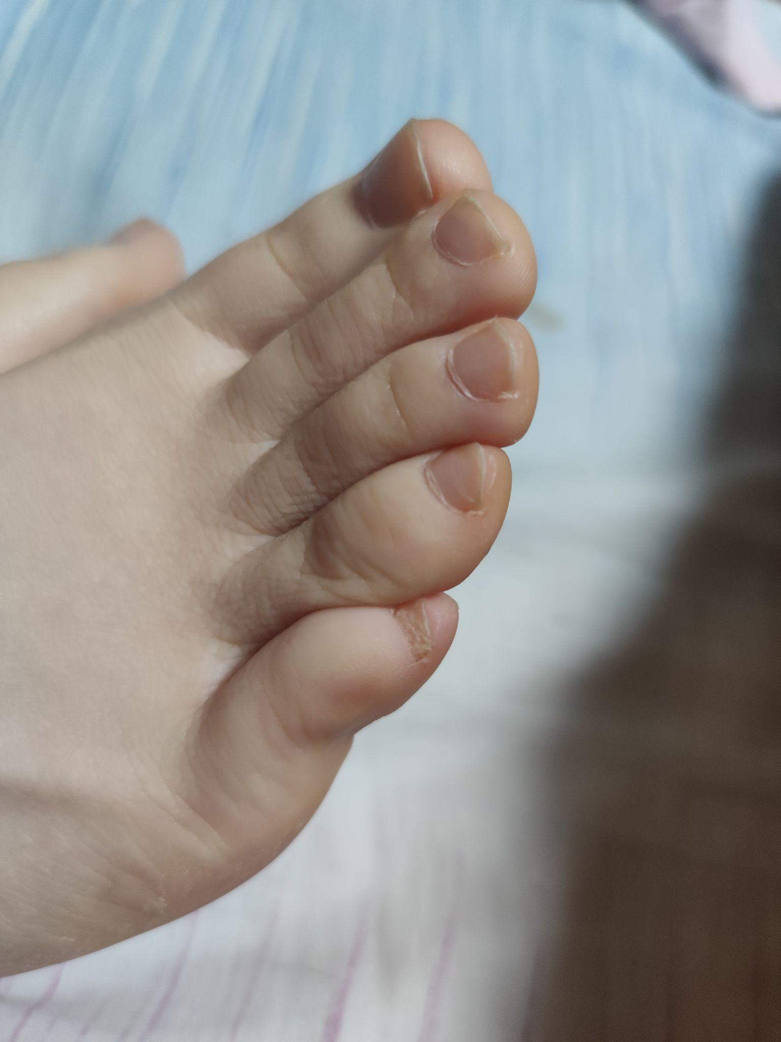 这属于小拇指内翻吗? - 知乎