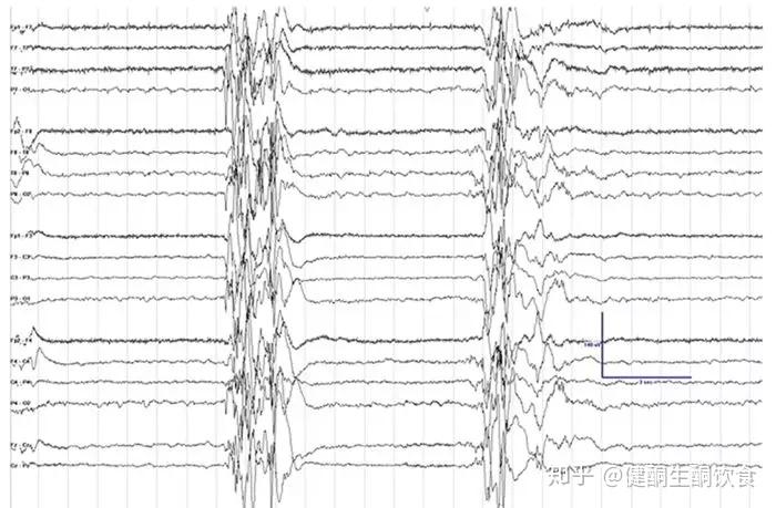 大田原综合征控制不了?试试生酮饮食治疗新方案