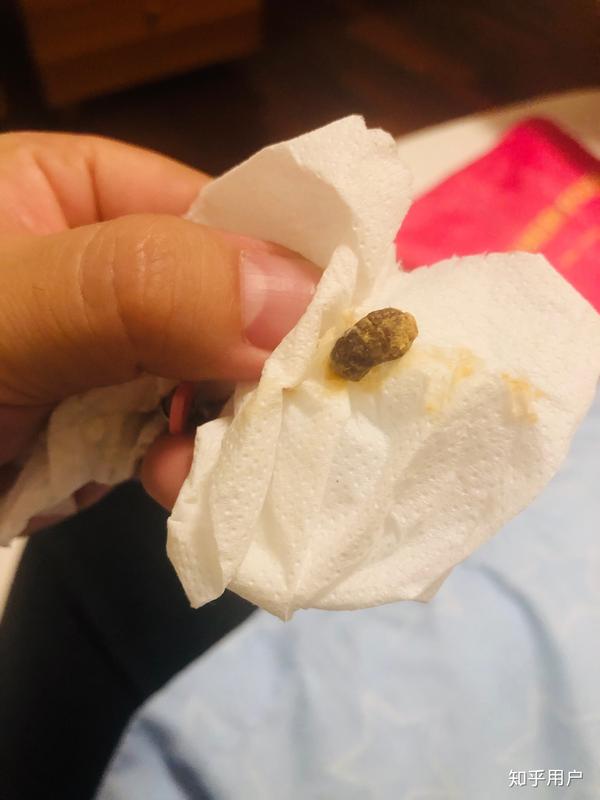 耳屎能大到什么程度?