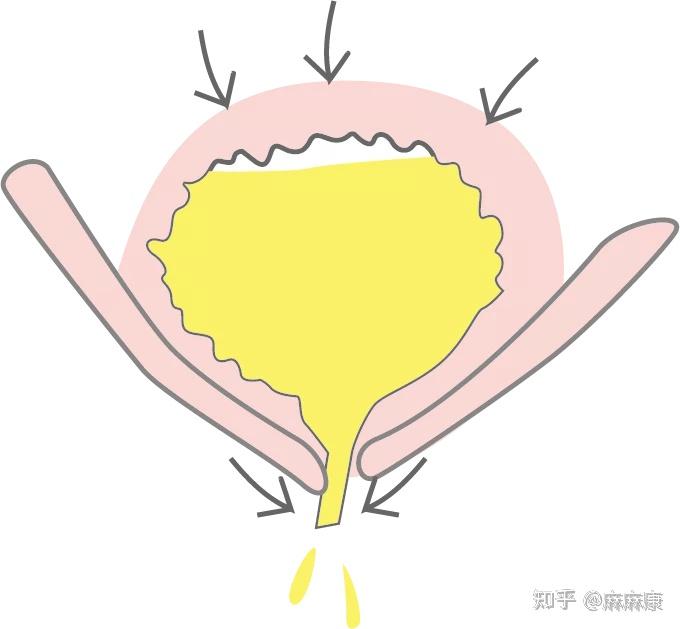 并且膀胱充盈,同时有饱胀感存在,那么,就可能已经患上尿潴留了