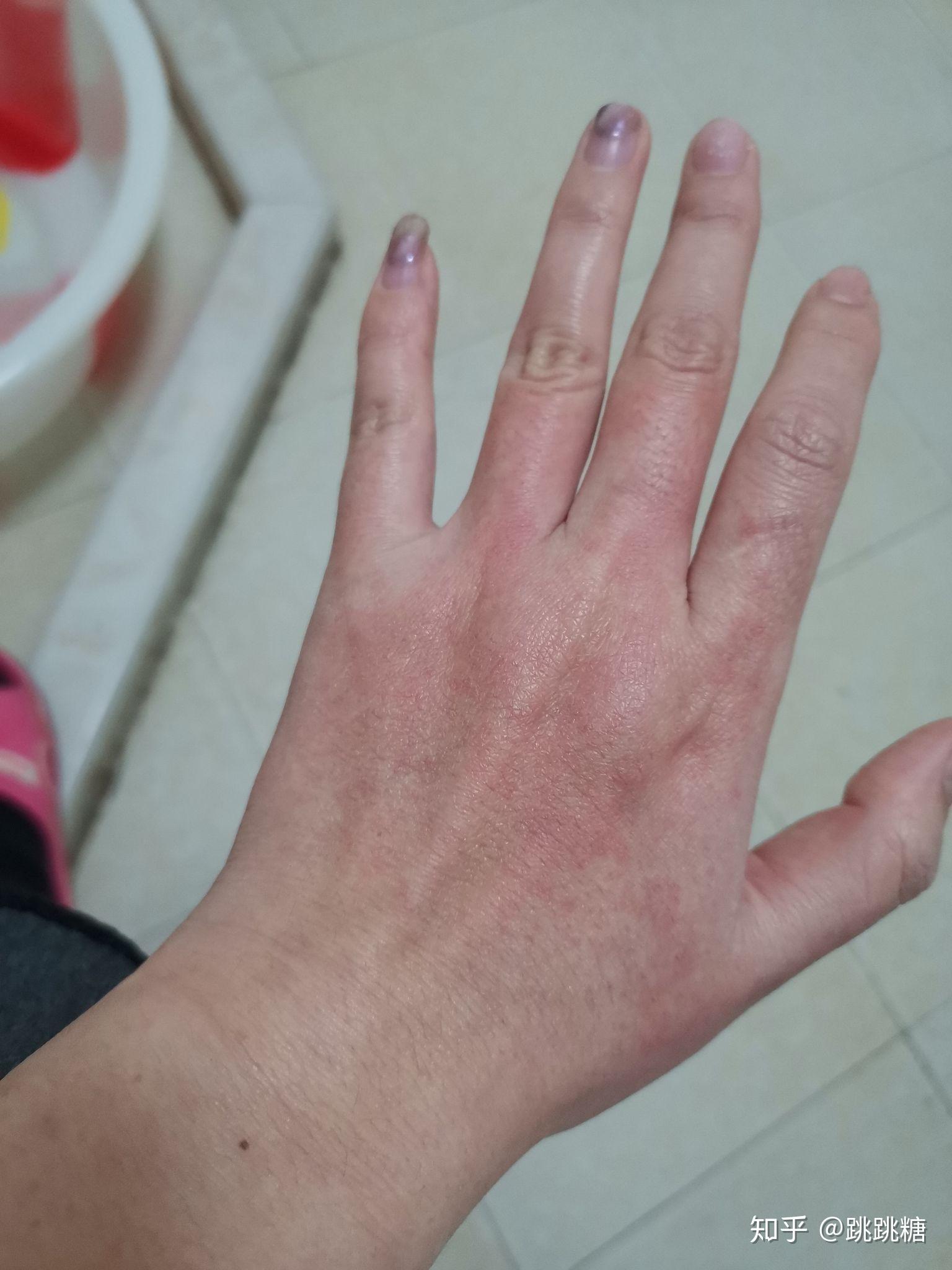 泰尔丝 异维A酸乳软胶囊手背上刺痛 - 知乎
