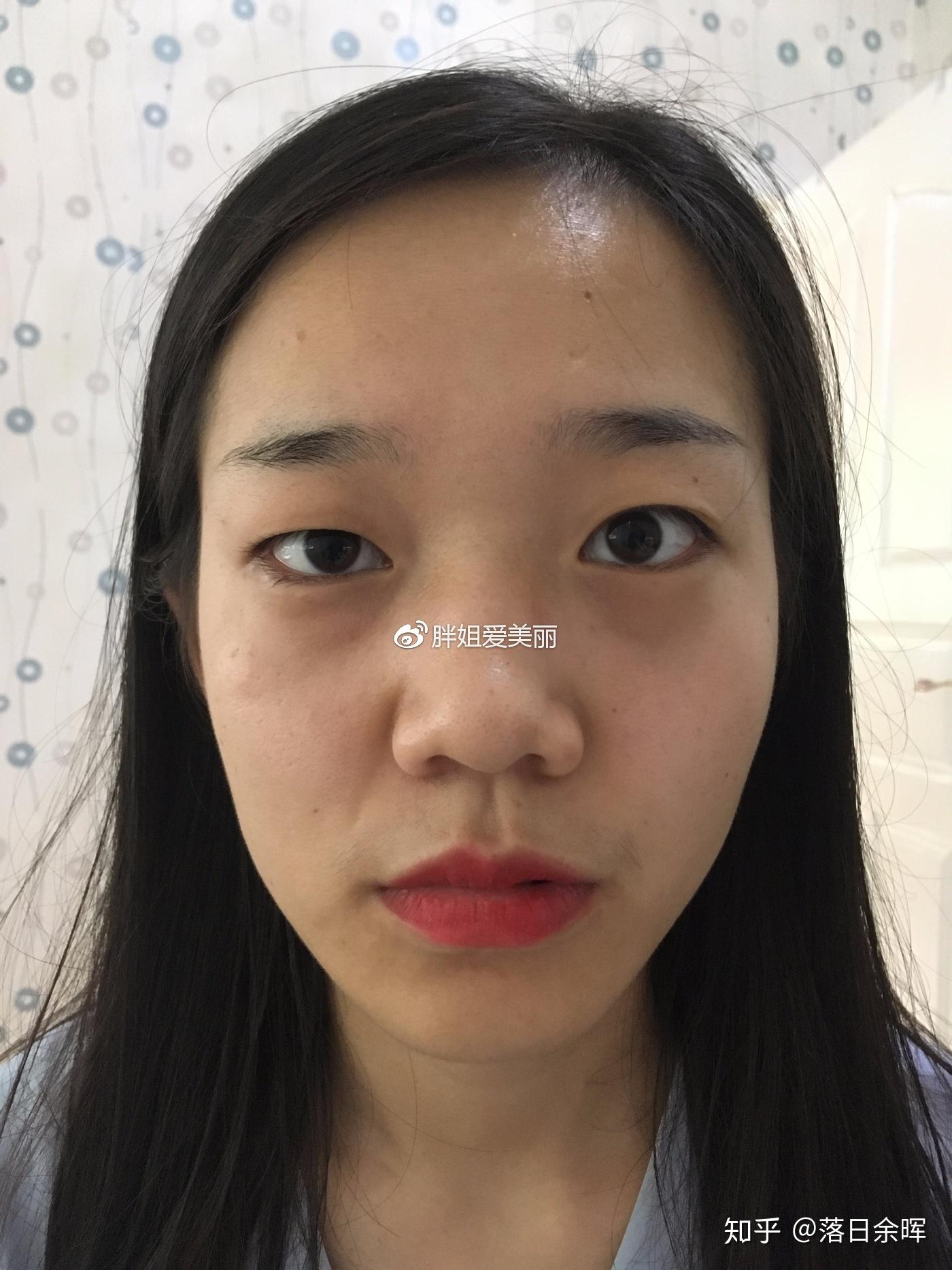 严重大小眼怎么办