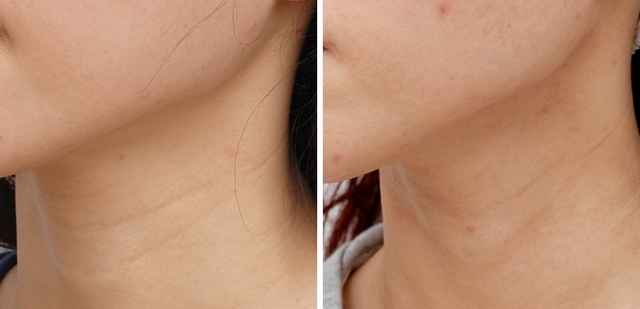 「颈纹」是如何形成的,预防其形成的措施有哪些? - 知乎