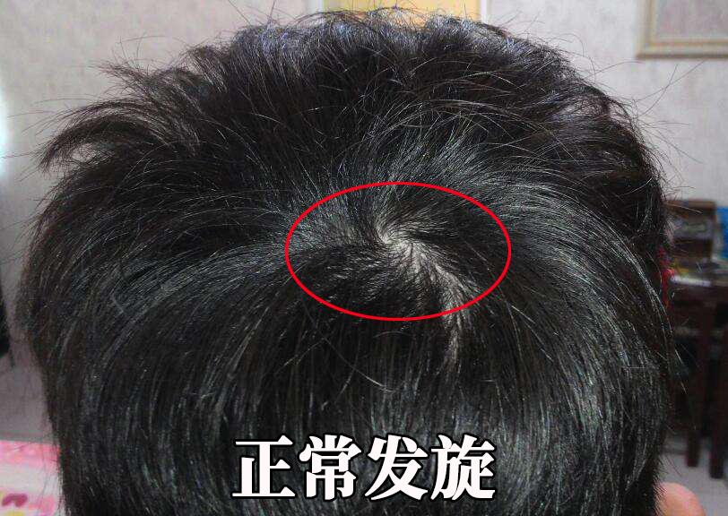 请教,后脑勺漩涡处头发我这样正常吗,这样算脱发吗? - 知乎