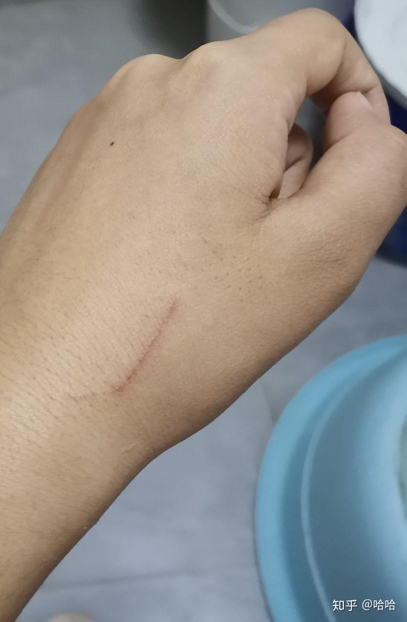 家里的狗养了六年了没打过疫苗 今天被它抓了一下 破一点皮 没出血