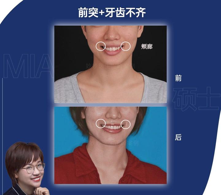 #中山牙齿矫正#中山整牙|面部微笑美学之笑线。 - 知乎