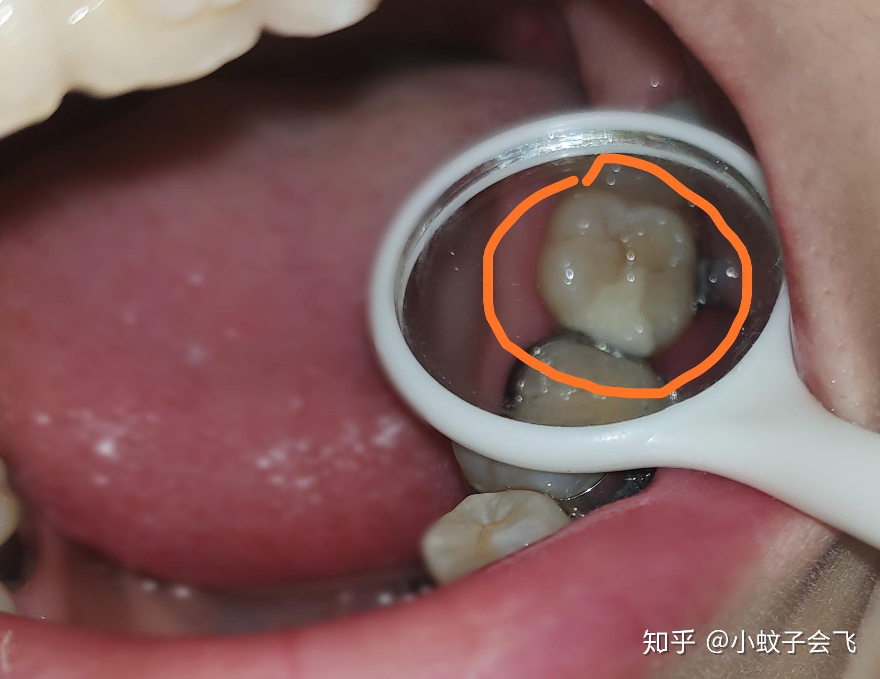 牙齿从表面看不出来,钻孔后发现坏了四分之一.