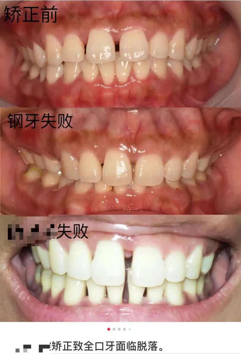 牙齿矫正致全口牙面临脱落 这几类人我真的不建议他们做矫正 知乎 牙齿矫正致全口牙面临脱落 这几类人我真的不建议他们做矫正 知乎