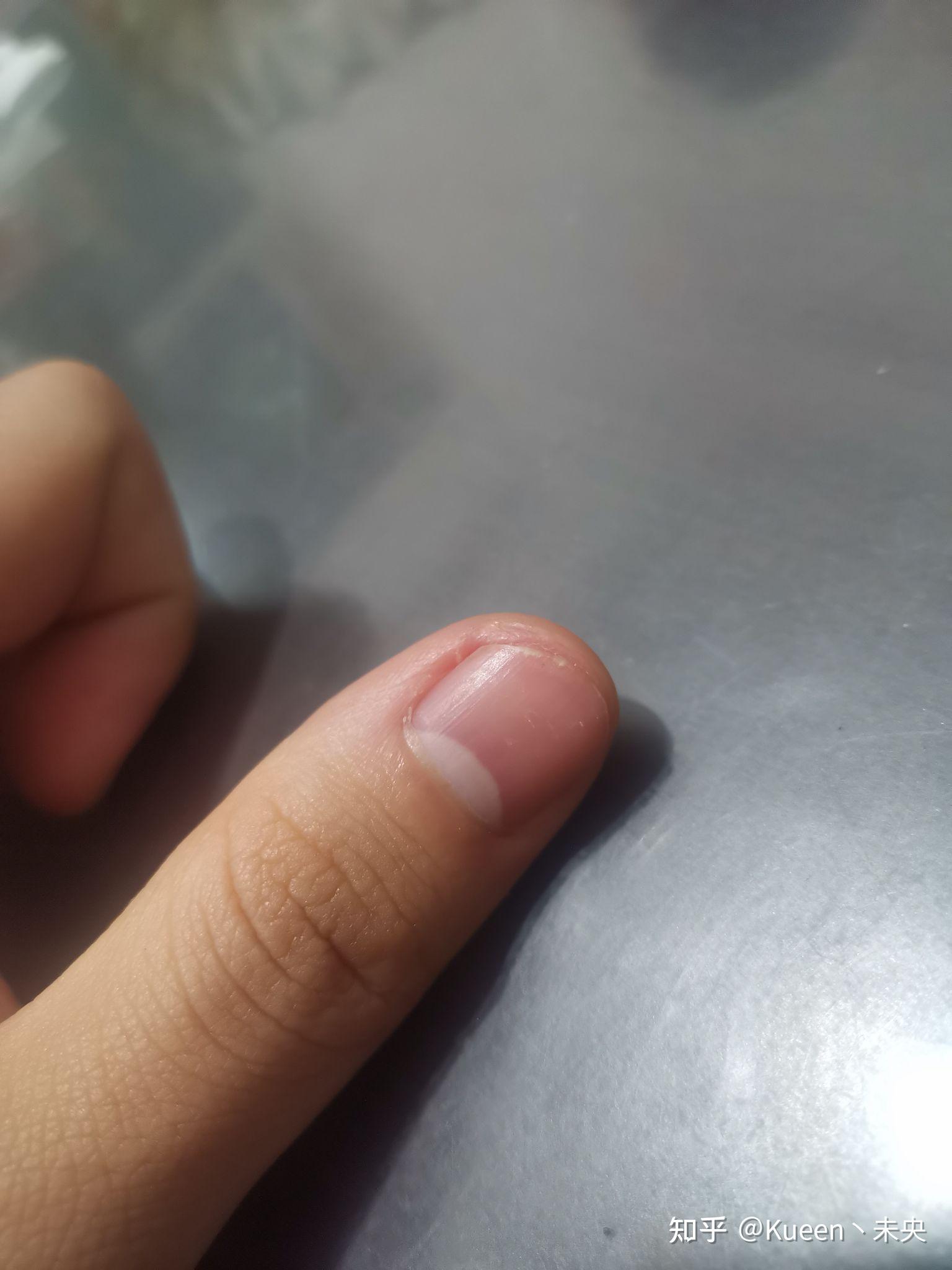 指甲从中间断了 怎么快速愈合? - 知乎
